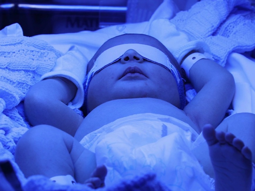 نوزاد با چشم بند مخصوص زیر نور فتوتراپی