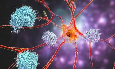 درمان بیماری آلزایمر